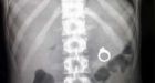 New Mexico woman accidentally swallows ring during marriage proposal