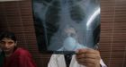 Tuberculosis claims 'staggering number of lives,' WHO says